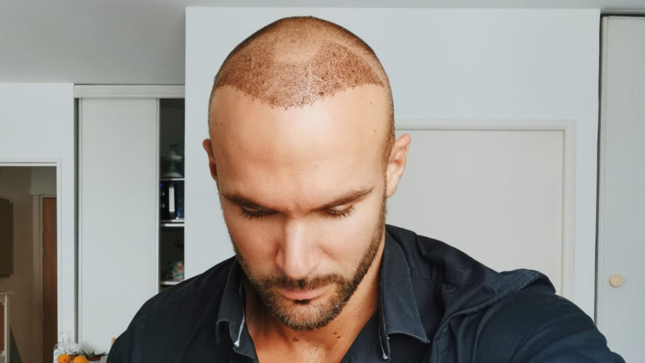 Hair Transplant Consultation – Personalized Treatment Plans